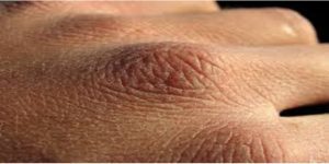 هل يتسبب المطهر الكحولي في سرطان الجلد؟! الكحول