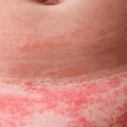 التهاب منطقة الحفاض