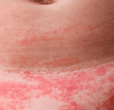 التهاب منطقة الحفاض