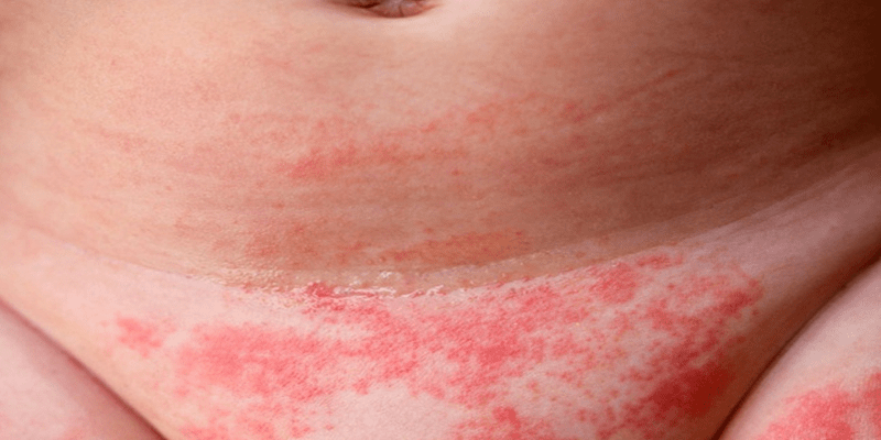 التهاب منطقة الحفاض