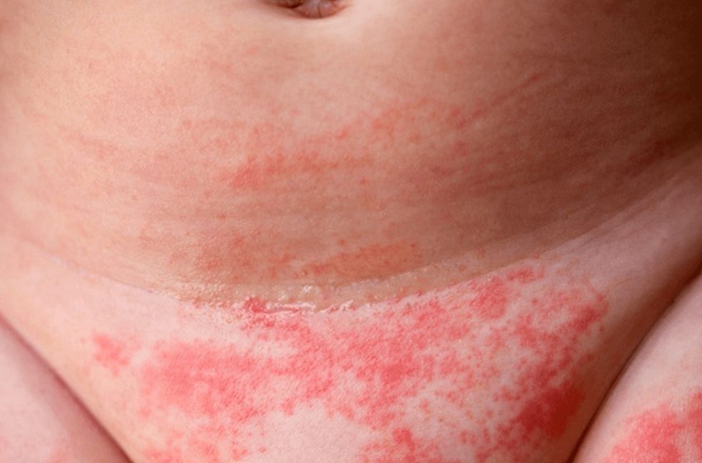 مامي جديدة (13) طفلك يعاني من التهاب منطقة الحفاض .. تعالي اعرفي الحل التهاب منطقة الحفاض