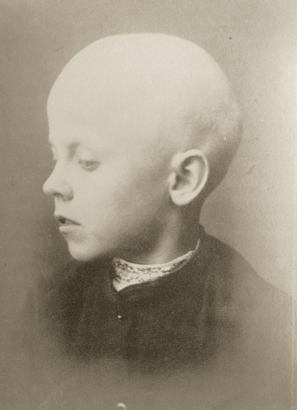 يوميات غرائب رمضان زمان (12) الصلع الجماعي يتفشى في أمريكا والنساء أول الضحايا طفل مصاب بالصلع