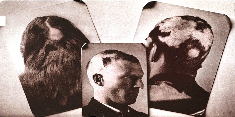 يوميات غرائب رمضان زمان (12) الصلع الجماعي يتفشى في أمريكا والنساء أول الضحايا الصلع الجماعي