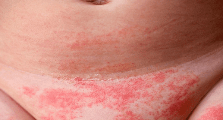 التهاب منطقة الحفاض