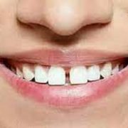 فلج الأسنان