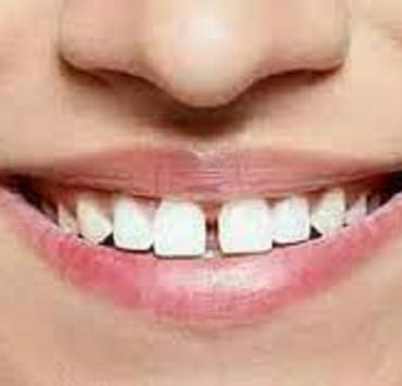 فلج الأسنان