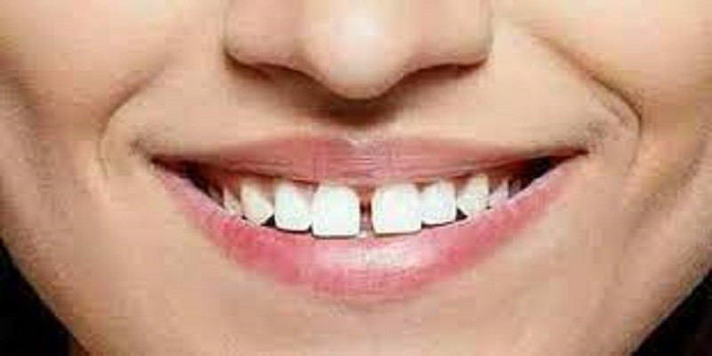 فلج الأسنان