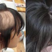 هوس نتف الشعر