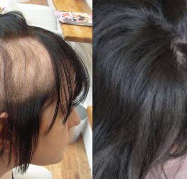 هوس نتف الشعر