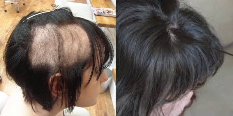 هوس نتف الشعر