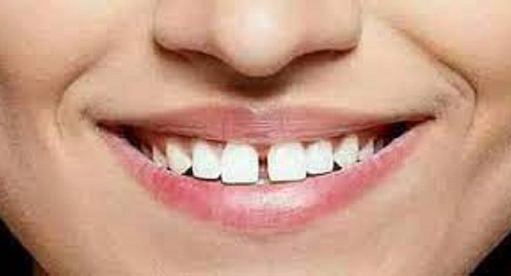 فلج الأسنان