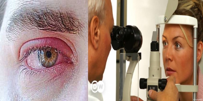 متلازمة سيكا