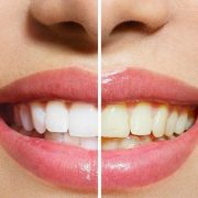 اصفرار الأسنان