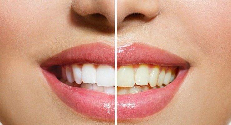 اصفرار الأسنان