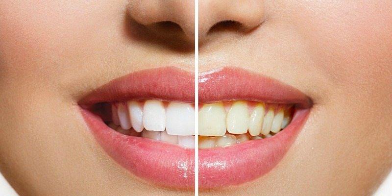 اصفرار الأسنان