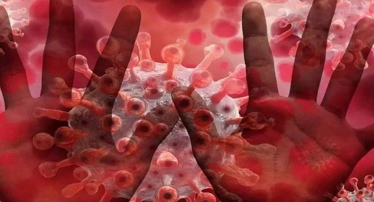 جدري القرود