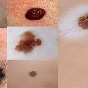 الشامات الجلدية