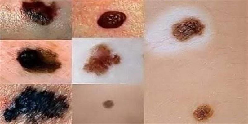 الشامات الجلدية