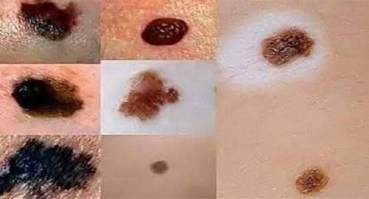 الشامات الجلدية