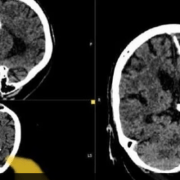 إبرة دخل دماغ سيدة