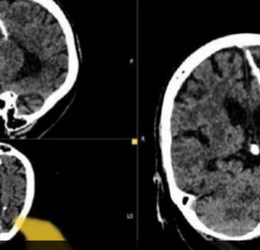 إبرة دخل دماغ سيدة