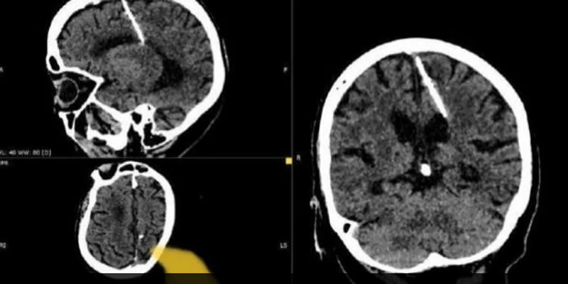 إبرة دخل دماغ سيدة