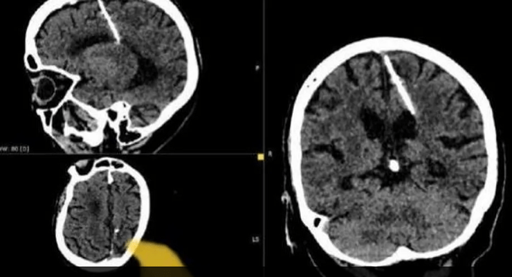 إبرة دخل دماغ سيدة