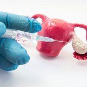 عملية تجميد البويضات