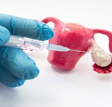 عملية تجميد البويضات