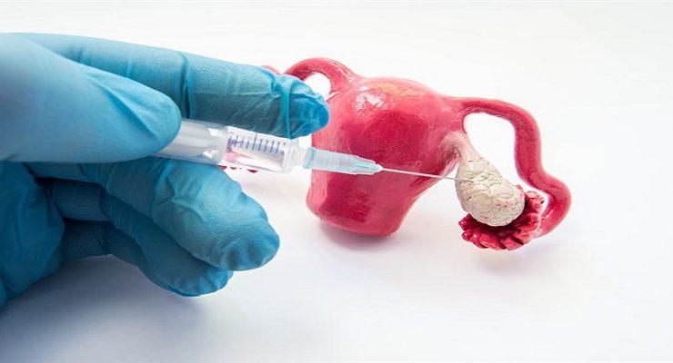 عملية تجميد البويضات